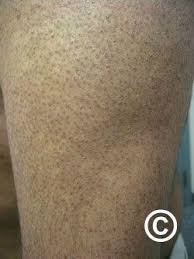 Image result for Keratosis pilaris