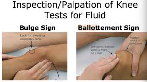 Image result for Knee Bulge Sign