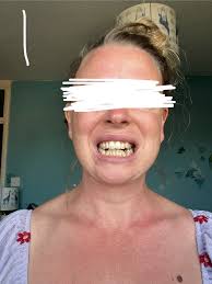 Time to Change Orthodontics. Dentists in the 19th century noticed that many  children were developing crooked teeth and used wires attached to vulcanite  plates to move the teeth into line. In the