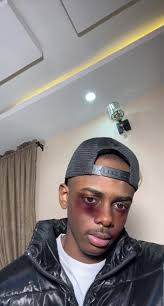 People's Reaction to Fake Injury Filters