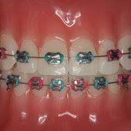 Finden sie braces on the teeth auf gigagünstig, die website, um preise zu vergleichen! Do You Need Braces Quizme