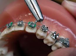 انواع تقويم الاسنان وأسعاره وعيوبه بالصور والتفاصيل Diy Braces Orthodontics Dental Braces