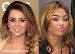 Botox On Young Female Celebrities Botox Before And After Botox Celebrities Female