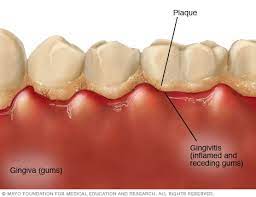 Maybe you would like to learn more about one of these? Gingivitis Symptoms And Causes Mayo Clinic