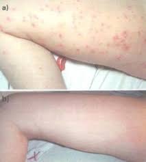 The result of the infection is usually a benign, mild skin disease characterized by lesions (growths) that may appear anywhere on the body. Molluscum Contagiosum Un Traitement A