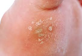 It wasn't a big deal and i. Plantar Wart Removal Treatment Causes Images Remedies Symptoms