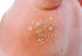plantar wart removal treatment causes