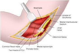 Cubital Tunnel Release St George Surgical Center