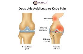 Image result for gout symptoms knee