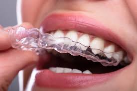 Your orthodontist will be able to give you an accurate estimate of how long your braces treatment will take based on their experience treating. Invisible Braces How To Straighten Your Teeth Using Clear Aligners
