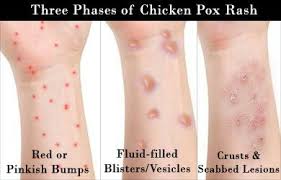 Image result for TESTIMONIset chicken pox shaklee