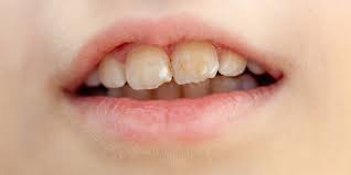 Image result for Tooth Discoloration