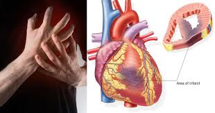 Image result for Myocardial Infarction Stabilization