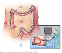 A flexible sigmoidoscopy or upper endoscopy generally takes. Colonoscopy Mayo Clinic