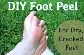 Other causes include, standing for long hours, using harsh soaps, cold weather, continuous exposure to water, being overweight, and wearing improper footwear. A Diy Peel For Dry Cracked Feet Bellatory Fashion And Beauty