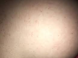 Spider angiomas are common in children and have been linked to pregnancy and liver conditions. Cherry Angiomas Dermatology Forums Patient