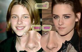 Kristen Stewart Nose Job Rumor Or Real Nose Job Nose Plastic Surgery Acne On Nose