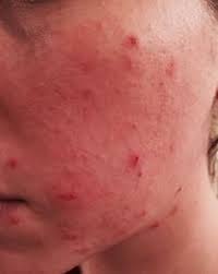 Sie suchen den besten sale? Pimple Scab Popped Get Rid Of Acne Scabs Fast Overnight Cover Heal Scab On Pimples Quickly Pimple Scab Acne Scabs How To Get Rid Of Pimples