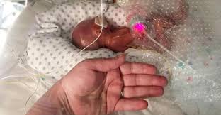 Descubre todos los síntomas que experimenta la madre en el embarazo semana a semana. Cuando Austin Nacio Tenia 22 Semanas Peso 635 Gramos Y Desafio Todos Los Pronosticos Viralistas Com