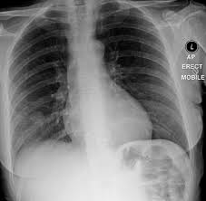 Who is most at risk of each? Coin Lesion Lung Radiology Reference Article Radiopaedia Org