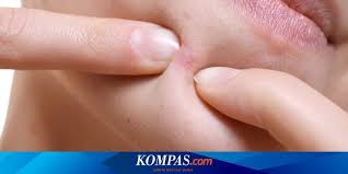 Atasi Jerawat Pakai Pasta Gigi Benarkah Ampuh Halaman All Kompas Com
