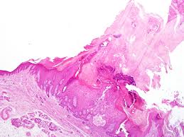 Image result for cornu cutaneum)