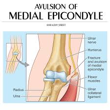 Treatment of fractures of the medial epicondyle of the humerus. Healthy Street Avulsion Of Medial Epicondyle Avulsion Facebook