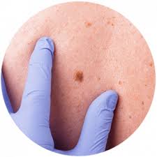 However, it may also be the most preventable. Skin Cancer Warning Signs What To Look For Galen Dermatology