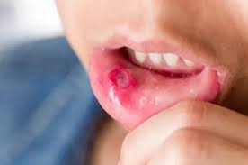 Image result for Mouth ulcers roof of mouth
