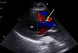 Image result for Left Ventricular Noncompaction
