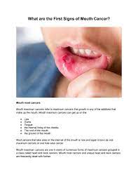 What do the first signs of mouth cancer look like? What Are The First Signs Of Mouth Cancer By Bruceaustin04 Issuu