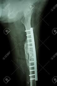 Bagaimanakah hukuman mencuri (mencopet) dan hukuman potong tangan dalam hukum islam? Tinta Mahyuddin 3 Bulan Untuk Operate Tulang Patah Facebook