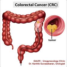 Ask your doctor when you should begin screening. Colon Colorectal Cancer Symptoms Diagnosis Gauri Urogynecology Clinic
