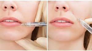 حقن الفيلر حول الفم نصائح ومعلومات حول حقن الفيلر عرب تركيا turkeytoarab