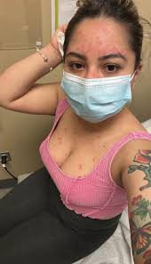 Hi, does anyone have any psoriasis diet plan and detox? Planning to do  detox then go