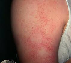 De fleste er ufarlige, men det er lurt å identifisere typen utslett for å være på den sikre siden. Utslett Pa Armene Oslo Hudlegesenter