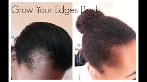 Sometimes simply addressing a medical condition prompting hair loss will be enough for the hair to regrow. How To Regrow Hairline Fast Boost Your Natural 4c Edges It Works