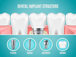 Big cost, but i asked for a discount if i paid it all up front, so i got $200 off, plus the dentist is bleaching my teeth for only $100 since he already has to do so some insurance plans do cover part of an implant. Tooth Implant Cost Every Tooth Implant Price In The Uk