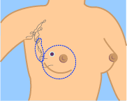 Image result for Mastectomy