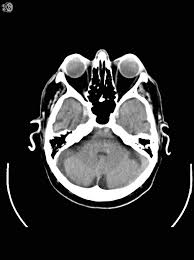 Image result for CT Head