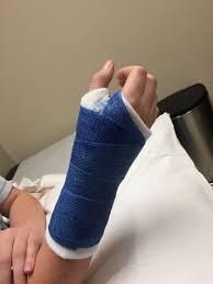Image result for Short Arm Cast