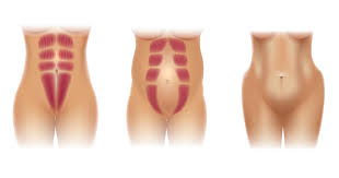 Innerhalb der ersten sechs wochen nach der geburt solltest du deinen arzt bitten, dir eine beckenbodenbehandlung beim krankengymnasten zu verschreiben, auch wenn du keine beschwerden hast. Rektusdiastase Nach Der Geburt Schwanger At