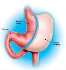 Western Bariatric Institute Vertical Sleeve Gastrectomy Gastric Sleeve Diet Sleeve Surgery Gastric Sleeve Surgery