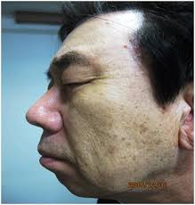 On the face lentigo maligna may be clinically mistaken for actinic lentigines 5. The Treatment Of Solar Lentigo Using Dr Hoon Hur S Optimal Melanocytic Suicide 2 Parameter With A High Fluence 1064nm Nd Yag Laser Without Postinflammatory Hyperpigmentation
