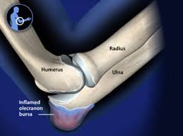 Bursitis Gelenk Klinik De