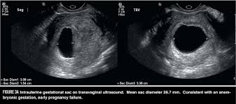 When A Pregnancy Fails Early Contemporary Ob Gyn