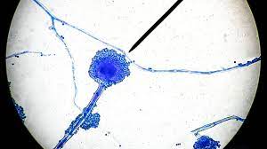 This infection is called mucormycosis. Potentially Fatal Black Fungus Infections On The Rise In India S Covid 19 Patients Live Science