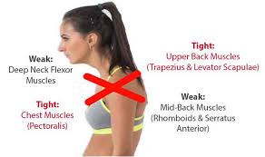 Cross Syndrome Causes Symptoms Diagnosis Treatment Exercises