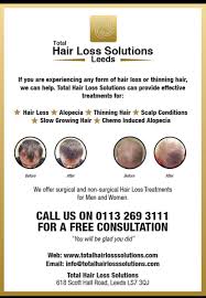 The cost of treating hair loss depends a lot on your individual case and the type of treatment you choose. Hairlosssolutions Hairlossleeds Twitter