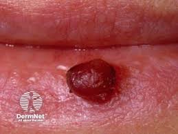 Image result for Pyogenic Granuloma